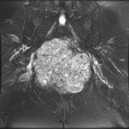 Sacral Chordoma MRI0002